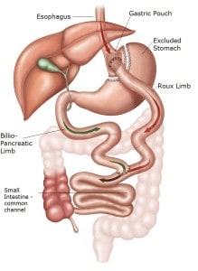 Gastric-Bypass pic