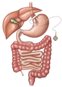 Gastric_Band_Image