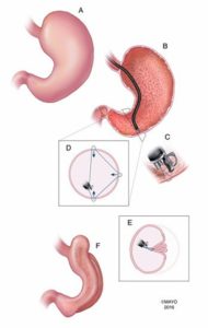 Houston Endoscopic Sleeve Gastroplasty