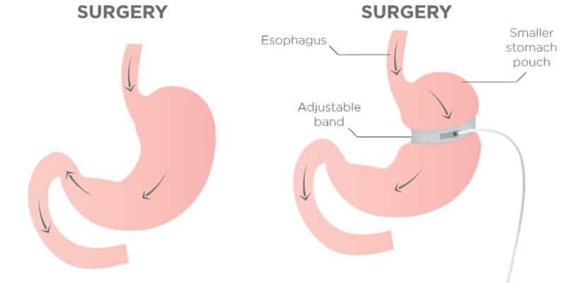 Lap Band Archives - Page 2 of 2 - Houston Weight Loss Surgery Center