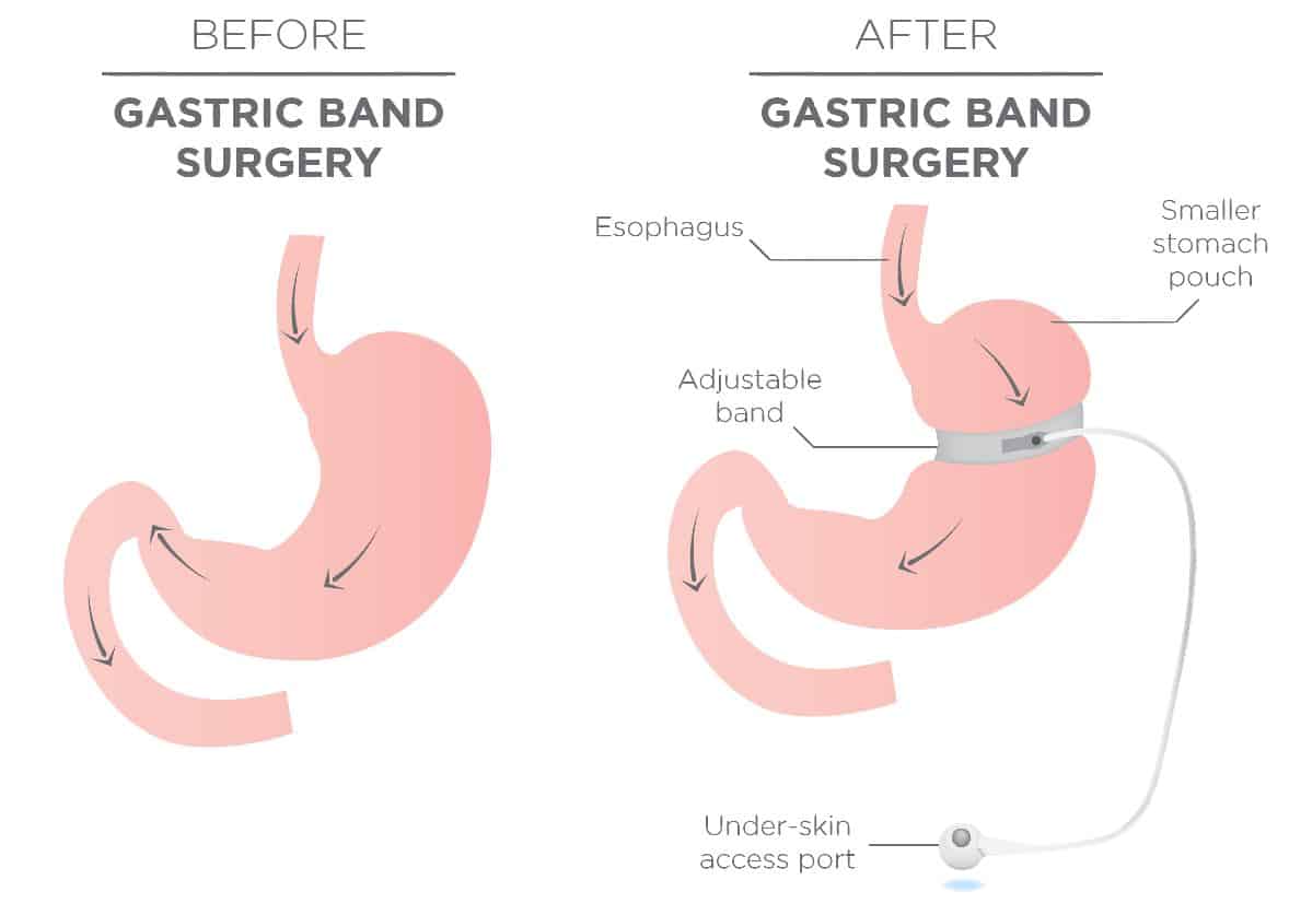 lap-band-surgery-houston