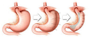 gastric bypass acid reflux houston