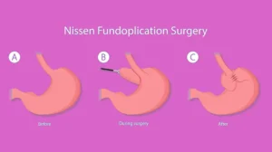 nissen fundoplication surgery diagram