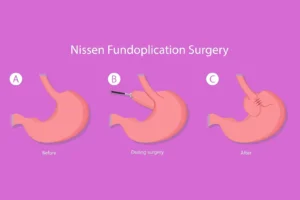 nissen fundoplication surgery diagram